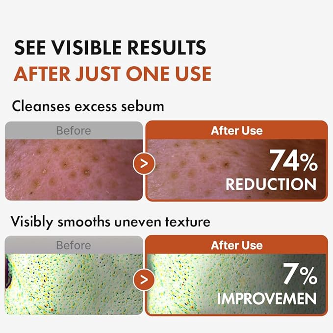 Hanskin BHA Pore Cleansing Oil, Gentle Blackhead Cleanser and Makeup Remover for Combination and Oily Skin, Korean Skincare [BHA/10.14 oz]