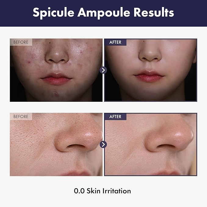 TOSOWOONG Real Spicule Ampoule with 30,000 Shots, Niacinamide, Panthenol, Liquid Skin Booster Serum, Pore Minimizer, Exfoliating, Dead Skin Cells, Skin Texture, Korean Skincare, 30ml, 1.01 fl. oz.