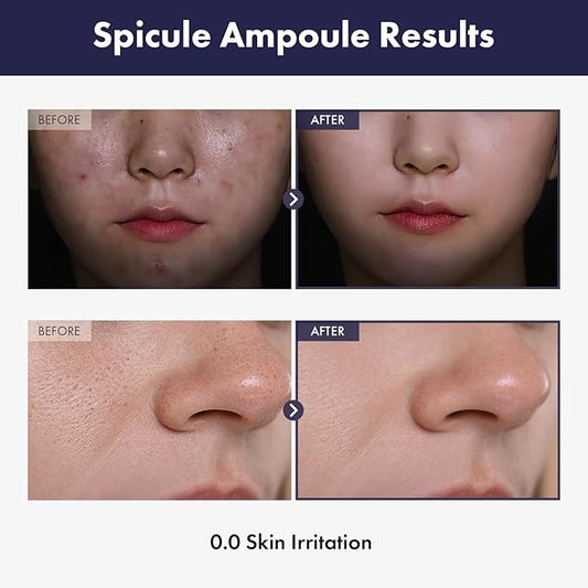 TOSOWOONG Real Spicule Ampoule with 30,000 Shots, Niacinamide, Panthenol, Liquid Skin Booster Serum, Pore Minimizer, Exfoliating, Dead Skin Cells, Skin Texture, Korean Skincare, 30ml, 1.01 fl. oz.